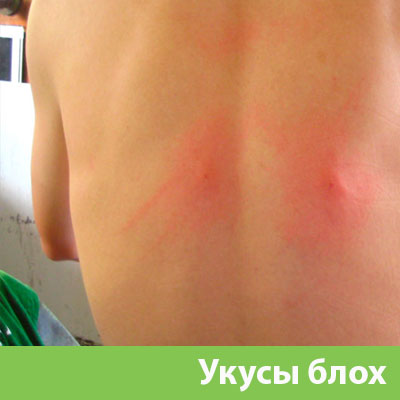 Укусы блох в Мичуринске