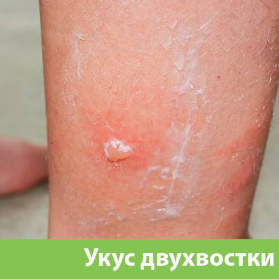 Укус двухвостки в Мичуринске