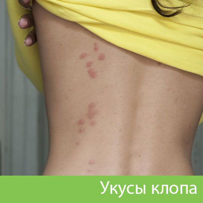 Профессиональное уничтожение клопов в Мичуринске